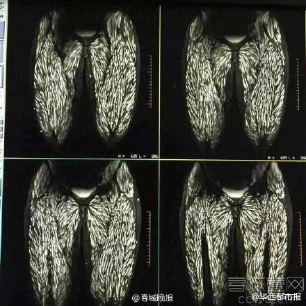恐怖云南一少女常吃生肉内脏长满虫密集恐惧症慎入