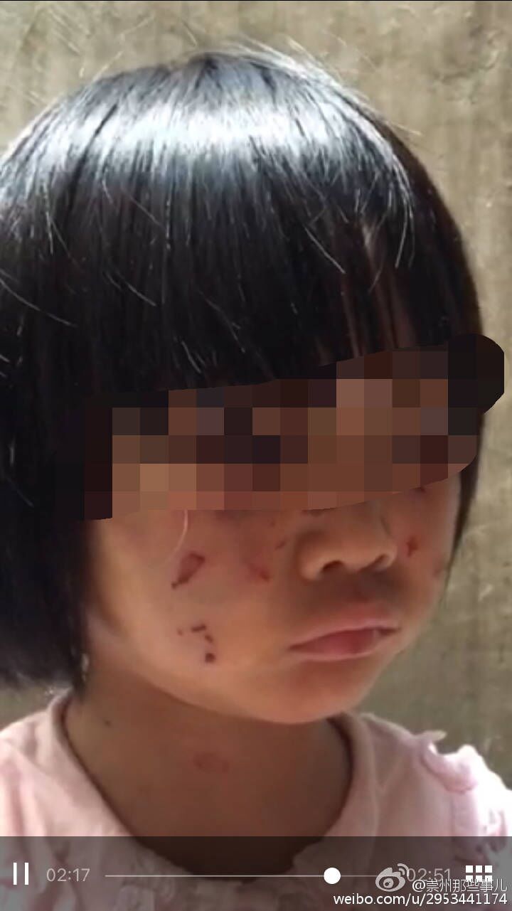 崇州一女孩疑似遭生父继母毒打 警方已拘留当事人